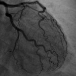 heart angiography image